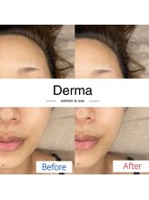 ダーマ(Derma)/フォト美顔　Before＆After