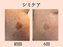 ウィズマツオカ 菊池本店/シミケア効果写真