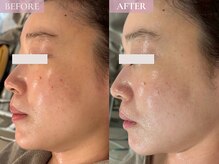 ベベ 表参道(bebe)/お悩み：赤み、くすみ