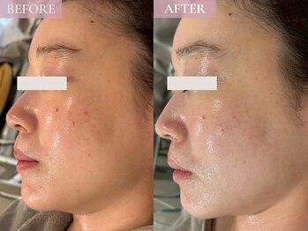 ベベ 表参道(bebe)/お悩み：赤み、くすみ