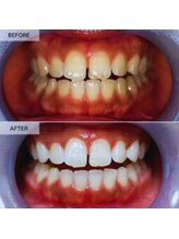 スマイルホワイト 赤羽店/ホワイトニングBefore After