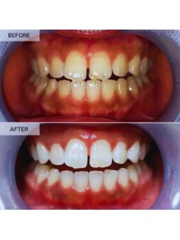 スマイルホワイト 赤羽店/ホワイトニングBefore After
