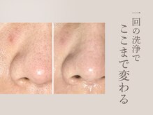 ラウン 京都(ROUN')/EIENで毛穴の芯から角栓を除去。