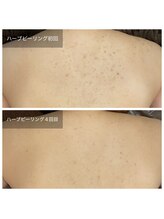 ビビ(VIVI)/背中ニキビに☆