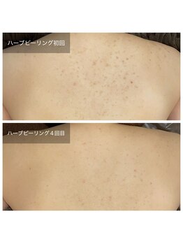 ビビ(VIVI)/背中ニキビに☆