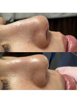 シンディー(CINDY)/毛穴洗浄