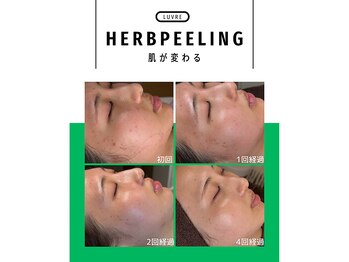 ルーヴレ(LUVRE)の写真/ニキビに悩んでいる方は是非ご来店下さい！効果絶大の韓国式ハーブピーリング♪