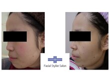 フェイシャルスタイリストサロン 高崎店(Facial Stylist Salon)/ケア例（17）