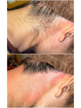 エースタイル(A-style.)/うなじ☆シュガーリング脱毛