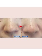 ハーゼ(Hase)/ハイドラフェイシャル◎毛穴洗浄