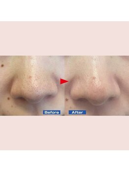 ハーゼ(Hase)/ハイドラフェイシャル◎毛穴洗浄