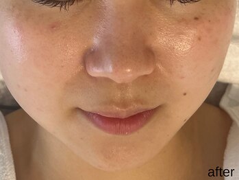 サロン ド エメ(salon de aimer)/【After】シミ分解!透明感!