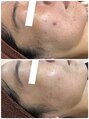 イリゼ(iriser)&nbsp;美肌専門店/徹底的に改善◎結果重視サロン/毛穴洗浄/毛穴吸引