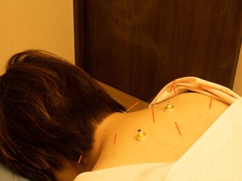 おさかべ鍼灸院の写真/至福の巧み技【はりきゅうコース¥4,300】国家資格・歴18年の院長が激コリ徹底改善!!当日予約◎