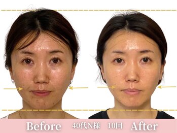 アメリイ 百合ヶ丘 新百合ヶ丘(Amerii)/小顔1回40代たるみ韓国女優顔に!