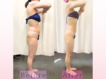 パラディ(PARADIS)の写真/【40代からの落ちないお腹に】集中引き締めケア