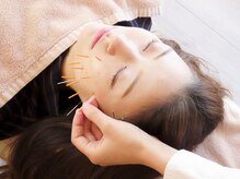 ハリナチュレ 大宮マルイ店/フェイスアップ美容鍼