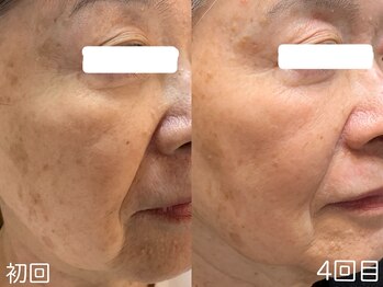 ハレオラ(HaleOla)/70代★1stSTEP4回目の変化♪