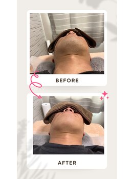 ラポール(Rapport)/アフター写真は6回目の3週間後