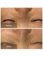 ルポアミ 代々木上原(REPOS AMI)/プラズマフェイシャル 5回の変化