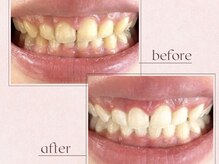 ルアナシンフォニア エクシア 恵比寿店(Luana-Sinfonia)/ホワイトニングビフォーアフター