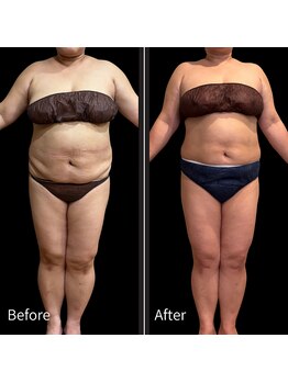 クールヴィラ(Cool Villa)/冷却3回痩身マッサージ3回