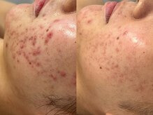 アンリミット 原宿竹下通り店(Une limit)/【3ヶ月間の肌変化】