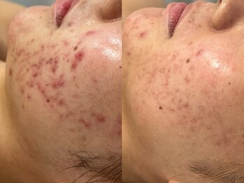 アンリミット 原宿竹下通り店(Une limit)/【3ヶ月間の肌変化】