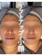 リルビー(Lilby)/リフトアップ・ハーブピーリング