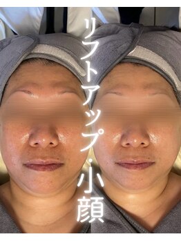 リルビー(Lilby)/リフトアップ・ハーブピーリング