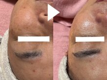 リコ(Ricco)/シミ、しわ、毛穴同時改善ハーブ