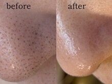 ウィズルーチェ 神栖店(with luce)/毛穴洗浄１回効果★鼻黒ずみ毛穴