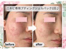 プラナ 町田(PRANA)の雰囲気(肌質改善!根本から解決!ニキビ専用ケア×ハーブピーリング)
