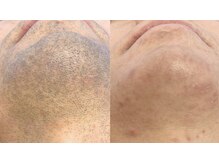 ラクーン(RACCOON)/【メンズ脱毛】顔