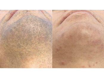 ラクーン(RACCOON)/【メンズ脱毛】顔