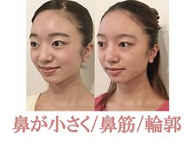 ラプリエイル 千葉店(Raplit aile)/隆鼻＋輪郭矯正40分10回