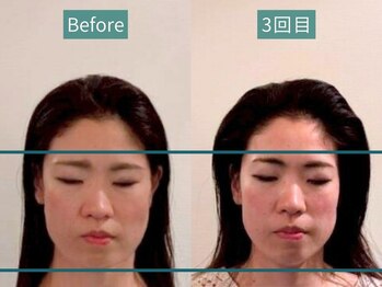 カンワ美容鍼灸院(KANWA美容鍼灸院)/顔の幅もたつきが悩み