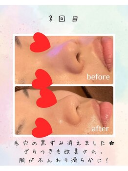 リリアン(lirien)/毛穴/毛穴ケア/毛穴洗浄/駒込