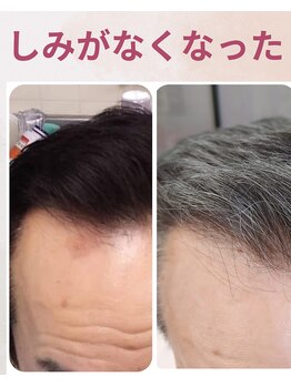 ララスマイル 鶴崎森町店/しみがなくなりました