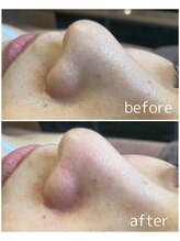 ベルシア(Belxia)/毛穴洗浄×ハーブピーリング症例