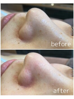 ベルシア(Belxia)/毛穴洗浄×ハーブピーリング症例