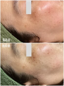 ブライトリー(Brightly)/施術直後から効果を実感!