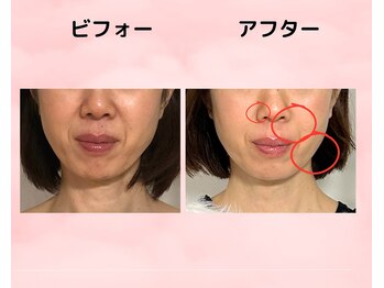 美カナエル(美kanaeru)/ほうれい線を改善！