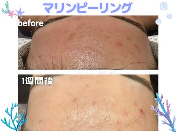 メイリリー 新宿(Meilily)/肌質改善☆マリンピーリング