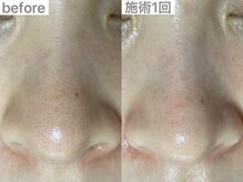 ユイット ルッカ(Huit Lucca)/ハイドラ×ララ×アクアダーマ