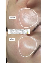 ミュウ(Miu.)/ハーブピーリングbefore/after