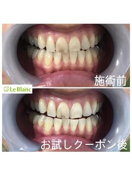 ルブラン 奈良店(Le Blanc)/目に見える着色汚れ