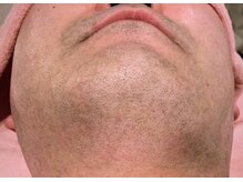 ディスイズミー(This is ME)/男性 お髭 初回施術前