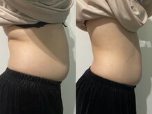 OBS/OBS痩身お腹集中(1ヶ月後)