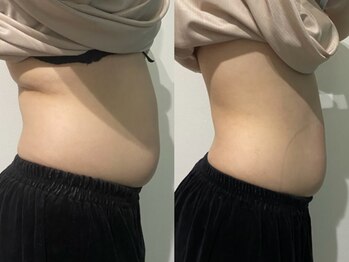 OBS/OBS痩身お腹集中(1ヶ月後)